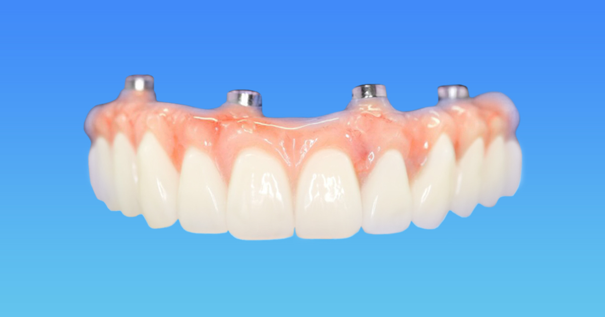 Bridge for Full Arch Rehab on Four Dental Implants