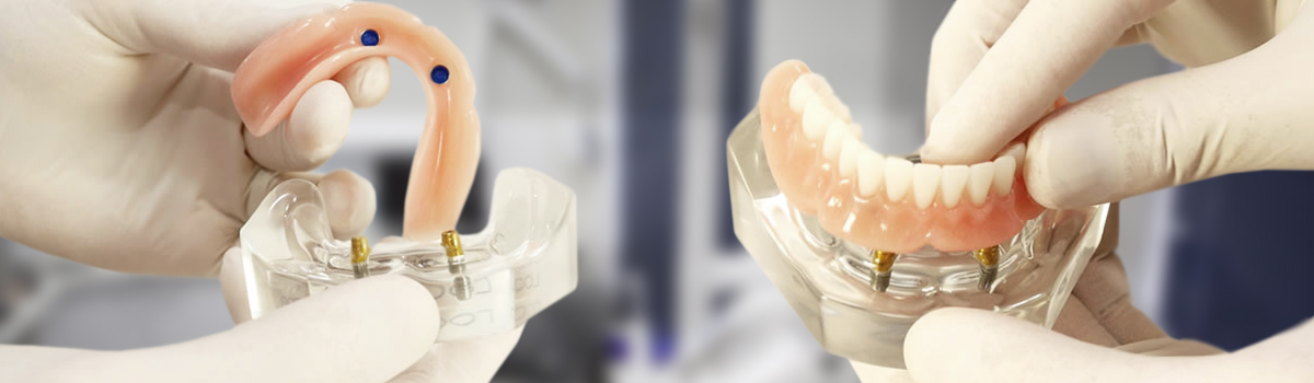 Dental Implant procedures in Leederville (Denture Connect Plus)